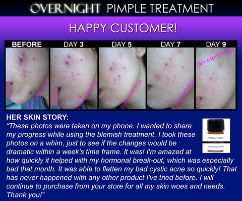 Overnight Pimple Treatment for Zits, Boils, Cysts Fast Remedy - DevotedThings