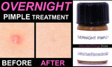 Overnight Pimple Treatment for Zits, Boils, Cysts Fast Remedy - DevotedThings
