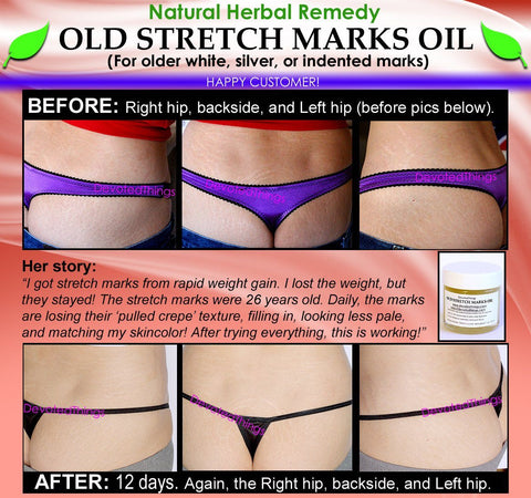 Natural Stretch Mark Remover Oil Herbal Remedy for Older White Silver Indented - DevotedThings