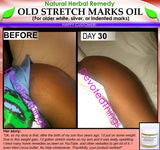 Natural Stretch Mark Remover Oil Herbal Remedy for Older White Silver Indented - DevotedThings