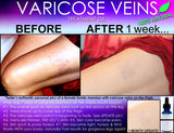 Natural Varicose Vein Treatment and Spider Vein Treatment 2 In 1 Stimulating Herbal Removal Oil - DevotedThings