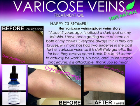 Natural Varicose Vein Treatment and Spider Vein Treatment 2 In 1 Stimulating Herbal Removal Oil - DevotedThings