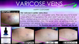Natural Varicose Vein Treatment and Spider Vein Treatment 2 In 1 Stimulating Herbal Removal Oil - DevotedThings