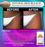 Natural Skin Bleaching Product That Works (Acne Scar Lightening, African American Skin Hyperpigmentation Spots)