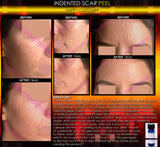 Treatment for Indented Scars Acne Chicken Pox Pitted Scar Removal Peel With Hyaluronic Acid