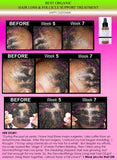 Organic Herbal Hair Loss Treatment, Hair Regrowth Support, and Anti Dandruff Spray - DevotedThings