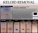 3 Day Peel For HPV Warts, Plantar Warts, Moles, Skin Tags, and Keloid Scars Removal Deepest Gentle Acid