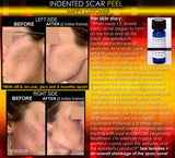Treatment for Indented Scars Acne Chicken Pox Pitted Scar Removal Peel With Hyaluronic Acid