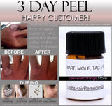 3 Day Peel For HPV Warts, Plantar Warts, Moles, Skin Tags, and Keloid Scars Removal Deepest Gentle Acid - DevotedThings