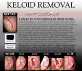 3 Day Peel For HPV Warts, Plantar Warts, Moles, Skin Tags, and Keloid Scars Removal Deepest Gentle Acid - DevotedThings