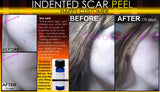 Treatment for Indented Scars Acne Chicken Pox Pitted Scar Removal Peel With Hyaluronic Acid - DevotedThings