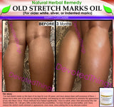 Natural Stretch Mark Remover Oil Herbal Remedy for Older White Silver Indented