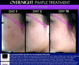 Overnight Pimple Treatment for Zits, Boils, Cysts Fast Remedy - DevotedThings