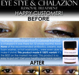 BEST Eye Stye Treatment and Chalazion Treatment 2 IN 1 Product Oil-Free - DevotedThings