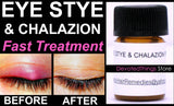 BEST Eye Stye Treatment and Chalazion Treatment 2 IN 1 Product Oil-Free - DevotedThings