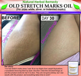 Natural Stretch Mark Remover Oil Herbal Remedy for Older White Silver Indented - DevotedThings