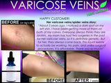 Natural Varicose Vein Treatment and Spider Vein Treatment 2 In 1 Stimulating Herbal Removal Oil - DevotedThings